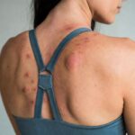 Friction Alopecia from Activewear: How Tight Sports Bras Damage Hair Follicles on the Upper Back