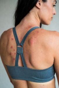 Friction Alopecia from Activewear: How Tight Sports Bras Damage Hair Follicles on the Upper Back